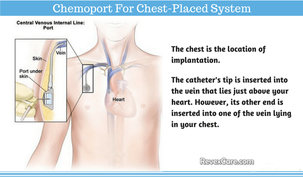 What is Chemoport Insertion and Placement Procedure?
