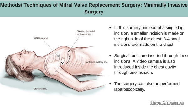 Mitral Valve Replacement Surgery Recovery And Follow Up