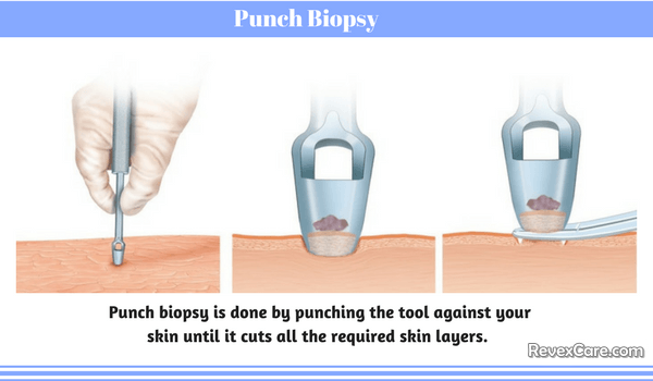 punch biopsy